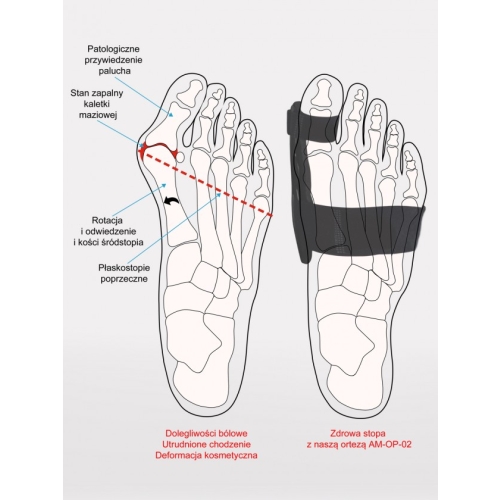 Orteza haluksa ze stabilizacją śródstopia AM-OP-02