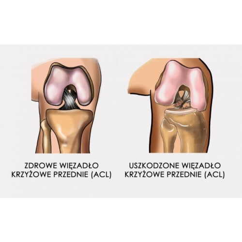 Orteza szkieletowa na goleń i udo z regulacją zakresu ruchomości i zegarami anatomicznymi ATOM/2RA