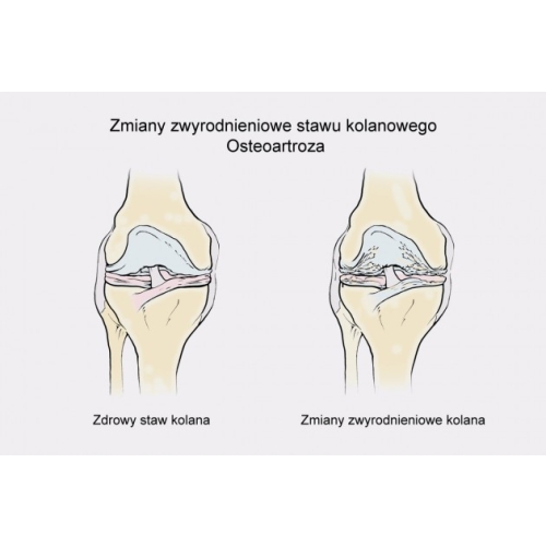 Jednoszynowa odciążająca orteza na goleń i udo z anatomiczną regulacją zakresu ruchomości i dynamicznymi pasami spiralnymi ATTACK 2RA